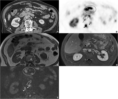 Evaluation of MRI in the diagnostic accuracy of extrahepatic metastases in neuroendocrine tumors in comparison with the reference standard somatostatin-receptor–PET/CT